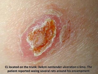 CL located on the trunk: 3x4cm nontender ulceration x 6mo. TheCL located on the trunk: 3x4cm nontender ulceration x 6mo. The
patient reported seeing several rats around his encampmentpatient reported seeing several rats around his encampment
 