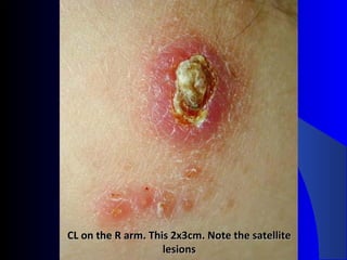 CL on the R arm. This 2x3cm. Note the satelliteCL on the R arm. This 2x3cm. Note the satellite
lesionslesions
 