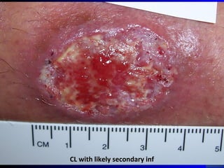 CL with likely secondary infCL with likely secondary inf
 