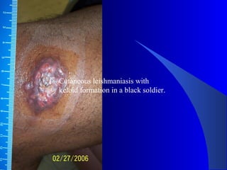 Cutaneous leishmaniasis with
keloid formation in a black soldier.
 