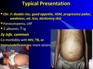 Typical PresentationTypical Presentation
Chr. F: double rise, good appetite, HSM, progressive pallor,Chr. F: double rise, good appetite, HSM, progressive pallor,
weakness, wt. loss, darkening skinweakness, wt. loss, darkening skin
Panacytopenia, LAPPanacytopenia, LAP
⇓⇓ albumin,albumin, ⇑⇑-Ig-Ig
2y infx. common2y infx. common
Co-morbidity withCo-morbidity with HIV, TB, orHIV, TB, or
Immunodeficiencies:Immunodeficiencies: more severemore severe
 