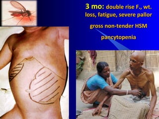 3 mo:3 mo: double rise F., wt.double rise F., wt.
loss, fatigue, severe pallorloss, fatigue, severe pallor
gross non-tender HSMgross non-tender HSM
pancytopeniapancytopenia
 