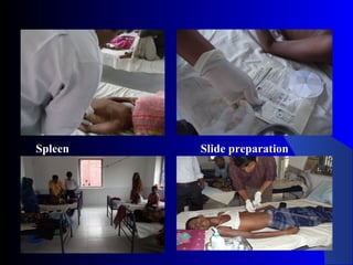 Spleen
puncture
Slide preparation
 