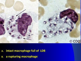 A.A. intact macrophage full of LDBintact macrophage full of LDB
B.B. a rupturing macrophagea rupturing macrophage
 