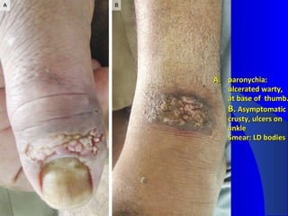 A.A. paronychia:paronychia:
ulcerated warty,ulcerated warty,
at base of thumb.at base of thumb.
B.B. AsymptomaticAsymptomatic
crusty, ulcers oncrusty, ulcers on
ankleankle
Smear: LD bodiesSmear: LD bodies
 