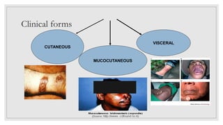 Clinical forms
VISCERAL
MUCOCUTANEOUS
CUTANEOUS
 