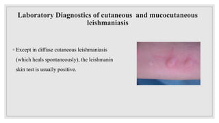 Laboratory Diagnostics of cutaneous and mucocutaneous
leishmaniasis
◦ Except in diffuse cutaneous leishmaniasis
(which heals spontaneously), the leishmanin
skin test is usually positive.
 