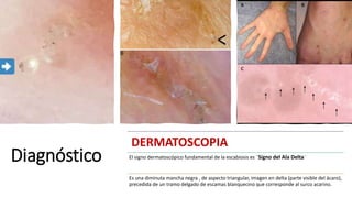 Diagnóstico
DERMATOSCOPIA
El signo dermatoscópico fundamental de la escabiosis es ¨Signo del Ala Delta¨
Es una diminuta mancha negra , de aspecto triangular, imagen en delta (parte visible del ácaro),
precedida de un tramo delgado de escamas blanquecino que corresponde al surco acarino.
 