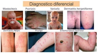 Diagnostico diferencial
Dermatitis Atópic Prurigo Eritema toxico neonatal
Mastocitosis Psoriasis Varicela Dermatitis herpetiforme
 
