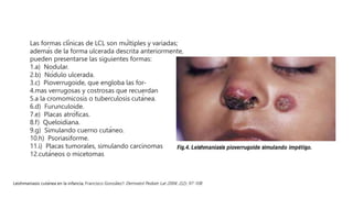 Las formas clínicas de LCL son múltiples y variadas;
además de la forma ulcerada descrita anteriormente,
pueden presentarse las siguientes formas:
1.a) Nodular.
2.b) Nódulo ulcerada.
3.c) Pioverrugoide, que engloba las for-
4.mas verrugosas y costrosas que recuerdan
5.a la cromomicosis o tuberculosis cutánea.
6.d) Furunculoide.
7.e) Placas atróficas.
8.f) Queloidiana.
9.g) Simulando cuerno cutáneo.
10.h) Psoriasiforme.
11.i) Placas tumorales, simulando carcinomas
12.cutáneos o micetomas
Leishmaniasis cutánea en la infancia, Francisco González1 Dermatol Pediatr Lat 2004; 2(2): 97-108
 