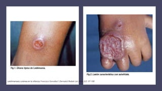 Leishmaniasis cutánea en la infancia, Francisco González1 Dermatol Pediatr Lat 2004; 2(2): 97-108
 