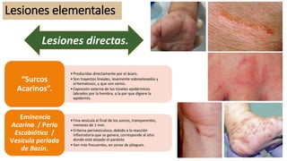 Lesiones elementales
•Producidas directamente por el ácaro.
•Son trayectos lineales, levemente sobreelevados y
eritematosos, y que son varios.
•Expresión externa de los túneles epidérmicos
labrados por la hembra, a la par que digiere la
epidermis.
“Surcos
Acarinos”.
•Fina vesícula al final de los surcos, transparentes,
menores de 1 mm.
•Eritema perivesiculoso, debido a la reacción
inflamatoria que se genera, corresponde al sitio
donde está alojado el parásito
•Son más frecuentes, en zonas de pliegues.
Eminencia
Acarina / Perla
Escabiótica /
Vesícula perlada
de Bazin.
Lesiones directas.
 