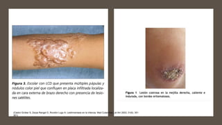 (Castro Grüber S, Zerpa Rangel O, Rondón Lugo A. Leishmaniasis en la infancia. Med Cutan Iber Lat Am 2003; 31(6): 351-
361)
 