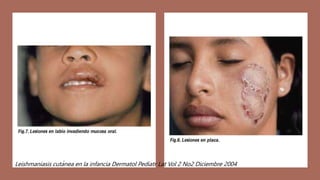 Leishmaniasis cutánea en la infancia Dermatol Pediatr Lat Vol 2 No2 Diciembre 2004
 