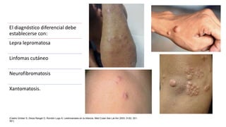 El diagnóstico diferencial debe
establecerse con:
Lepra lepromatosa
Linfomas cutáneo
Neurofibromatosis
Xantomatosis.
(Castro Grüber S, Zerpa Rangel O, Rondón Lugo A. Leishmaniasis en la infancia. Med Cutan Iber Lat Am 2003; 31(6): 351-
361)
 
