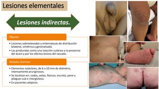 Lesiones elementales
• Lesiones sobreelevadas y eritematosas de distribución
bilateral, simétrica y generalizada.
• Las producidas como una reacción cutánea a la presencia
del ácaro y por los efectos lesivos del rascado.
Pápulas
• Elementos nodulares, de 6 a 10 mm de diámetro,
intensamente pruriginosos.
• Se localizan en: codos, axilas, flancos, escroto, pene y
pliegues sub e interglúteos.
• En pacientes atópicos.
Nódulos Acarinos
Lesiones indirectas.
 