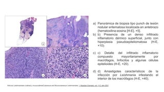a) Panorámica de biopsia tipo punch de lesión
nodular eritematosa localizada en antebrazo
(hematoxilina-eosina [H-E], ×5].
b) b) Presencia de un denso infiltrado
inflamatorio dérmico superficial, junto con
hiperplasia pseudoepiteliomatosa (H-E,
×10).
c) c) Detalle del infiltrado inflamatorio
compuesto mayoritariamente por
macrófagos, linfocitos y algunas células
epitelioides (H-E, ×20).
d) d) Amastigotes característicos de la
infección por Leishmania infestando el
interior de los macrófagos (H-E, ×40).
Artículo Leishmaniasis cutánea y mucocutáneaCutaneous and Mucocutaneous Leishmaniasis, I. Abadías-Granado, vol. 112, año 2021
 