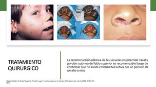 TRATAMIENTO
QUIRURGICO
La reconstrucción plástica de las secuelas en pirámide nasal y
porción cutánea del labio superior es recomendable luego de
confirmar que no existe enfermedad activa por un periodo de
un año o más
(Castro Grüber S, Zerpa Rangel O, Rondón Lugo A. Leishmaniasis en la infancia. Med Cutan Iber Lat Am 2003; 31(6): 351-
361)
 
