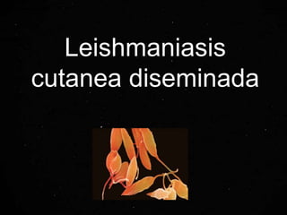 Leishmaniasis
cutanea diseminada
 
