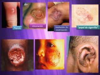 Ulceración   Involución. En
Pápula                                  “papel de cigarrillo”.
                       cicatrización.
 