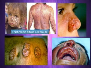 Leishmania difusa o leproide
 