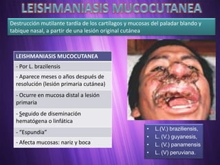 Destrucción mutilante tardía de los cartílagos y mucosas del paladar blando y
tabique nasal, a partir de una lesión original cutánea



  LEISHMANIASIS MUCOCUTANEA
  - Por L. brazilensis
  - Aparece meses o años después de
  resolución (lesión primaria cutánea)
  - Ocurre en mucosa distal a lesión
  primaria
  - Seguido de diseminación
  hematógena o linfática
                                                       •   L.(V.) braziliensis,
  - “Espundia”
                                                       •   L. (V.) guyanesis,
  - Afecta mucosas: nariz y boca                       •   L. (V.) panamensis
                                                       •   L. (V) peruviana.
 