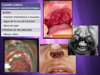 CUADRO CLÍNICO:
LEISHMANIASIS MUCOCUTANEA
LESIÓN:
- Invasión metastásica a mucosas
- Signo de la cruz de Escomel
- Nariz de tapir
PERIODO DE INCUBACIÓN:
- Meses- Años
                                   Cruz de Escomel
 