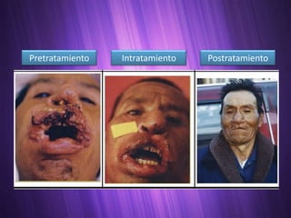 Pretratamiento   Intratamiento   Postratamiento
 