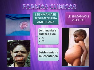 LEISHMANIASIS
                  LEISHMANIASIS
TEGUMENTARIA
                     VISCERAL
  AMERICANA

  Leishmaniasis
  cutánea pura
  • LCL
  • LCD



  Leishmaniasis
  mucocutanea
 