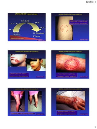 29/02/2012




          LEISHMANIASIS respuesta inmune                           LEISHMANIASIS TEGUMENTARIA AMERICANA




                     LM / LMC                                                            PRIMOINFECCION CUTANEA
                                        LC R
LC 1° + M                                                                                Lesiones precoces variceliformes


                                                  LC D
LC 1°
     Infección                       LC Diseminada
     subclínica
                                     L Visceral
 Inmunidad del húesped                                                                                      EXPRESION CLINICA
                                            EXPRESION CLINICA




         LEISHMANIASIS TEGUMENTARIA AMERICANA                      LEISHMANIASIS TEGUMENTARIA AMERICANA




 PRIMOINFECCION CUTANEA                                           PRIMOINFECCION CUTANEA
Lesión necrótico-ulcerosa temprana        EXPRESION CLINICA     Lesión única. Ulcera “en molde”             EXPRESION CLINICA




         LEISHMANIASIS TEGUMENTARIA AMERICANA                      LEISHMANIASIS TEGUMENTARIA AMERICANA




                                                                 PRIMOINFECCION CUTANEA
  PRIMOINFECCION CUTANEA MULTIPLE         EXPRESION CLINICA     Linfangítica-nodular (esporotricoide)       EXPRESION CLINICA




                                                                                                                                 3
 