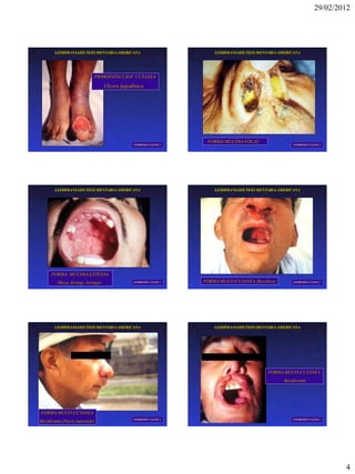 29/02/2012




       LEISHMANIASIS TEGUMENTARIA AMERICANA                             LEISHMANIASIS TEGUMENTARIA AMERICANA




                             PRIMOINFECCION CUTANEA

                                    Ulcera fagedénica




                                                                     FORMA MUCOSA FOCAL
                                                EXPRESION CLINICA                                        EXPRESION CLINICA




       LEISHMANIASIS TEGUMENTARIA AMERICANA                             LEISHMANIASIS TEGUMENTARIA AMERICANA




      FORMA MUCOSA EXTENSA
         (Boca, faringe, laringe)               EXPRESION CLINICA   FORMA MUCO-CUTANEA (Recidiva)        EXPRESION CLINICA




       LEISHMANIASIS TEGUMENTARIA AMERICANA                             LEISHMANIASIS TEGUMENTARIA AMERICANA




                                                                                              FORMA MUCO-CUTANEA
                                                                                                     Recidivante




FORMA MUCO-CUTANEA
                                                EXPRESION CLINICA                                        EXPRESION CLINICA
Recidivante (Nariz tapiroide)




                                                                                                                              4
 