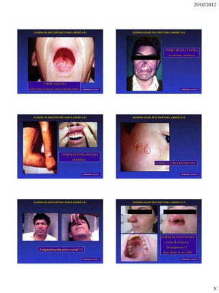 29/02/2012




    LEISHMANIASIS TEGUMENTARIA AMERICANA                            LEISHMANIASIS TEGUMENTARIA AMERICANA




                                                                                          FORMA MUCO-CUTANEA
                                                                                            (recidivante, mutilante)




             FORMA MUCOSA
(retracción cicatrizal, alteración funcional)   EXPRESION CLINICA                                       EXPRESION CLINICA




    LEISHMANIASIS TEGUMENTARIA AMERICANA                            LEISHMANIASIS TEGUMENTARIA AMERICANA




                              FORMA CUTANEA-MUCOSA
                                       Simultánea
                                                                                   FORMA CUTANEA RECIDIVANS


                                                EXPRESION CLINICA                                       EXPRESION CLINICA




    LEISHMANIASIS TEGUMENTARIA AMERICANA                            LEISHMANIASIS TEGUMENTARIA AMERICANA




                                                                                       FORMA MUCO-CUTANEA
                                                                                          4 años de evolución
                                                                                           Sin diagnóstico !!!
         Estigmatización psico-social !!!
                                                                                        Htal. Muñiz 14 nov. 2005

                                                EXPRESION CLINICA                                       EXPRESION CLINICA




                                                                                                                             5
 