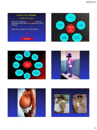 29/02/2012




            LEISHMANIASIS VISCERAL
                                                                                                          EDAD
                 Complicaciones clínicas                                                             < 1 a o > 65 a




   Infecciones secundarias: bacterianas (neumonía,
    infecciones de piel, diarrea, IU), infecciones virales,
    micóticas.                                                                DESNUTRICION
                                                                                 GRAVE
                                                                                                                                  EDEMA
                                                                                                                                LOCALIZADO
                                                                                                      SIGNOS
                                                                                                     CLINICOS
   Sangrados (secundarios a trombocitopenia)                                                           DE
                                                                                                     ALARMA



                                                                                        FIEBRE DE                       PRESENCIA
                                                                                       >60 DÍAS DE                         DE
                                                                                       EVOLUCIÓN                      COMORBILIDADES
                          MUERTE
                                                                                                                                   LV grave M. Brasil 2006




                           Leucocitos
                            <1000 o
                           neutrófilos
                             < 500          Rx
            Plaquetas                     Edema
             < 50000                     pulmonar




                          ALTERACION
        Hb < 7              LAB. DE             Albúmina
         gr/dl             GRAVEDAD            < 2,5 mg/ml




             Creatinina                      Tpo
              elevada                    Protrombina
                                            < 70%
                            Bi y
                            TGO
                           TGP x 5                  LV grave M. Brasil 2006




                                                                                                                                                             8
 