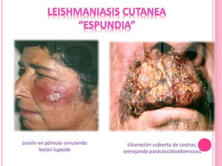 Lesión en pómulo simulando
lesión lupoide
Ulceración cubierta de costras,
semejando paracoccidioidomicosis
 