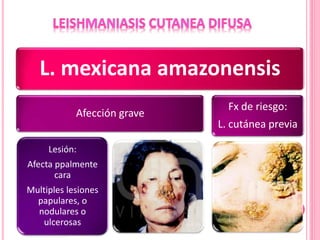 L. mexicana amazonensis
Afección grave
Lesión:
Afecta ppalmente
cara
Multiples lesiones
papulares, o
nodulares o
ulcerosas
Fx de riesgo:
L. cutánea previa
 