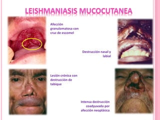 Afección
granulomatosa con
cruz de escomel
Destrucción nasal y
labial
Lesión crónica con
destrucción de
tabique
Intensa destrucción
coadyuvada por
afección neoplásica
 