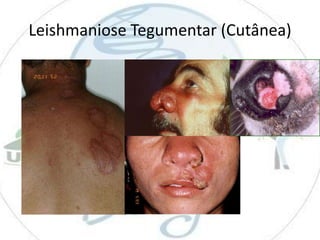 Leishmaniose Tegumentar (Cutânea)

 