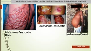 Leishmaniose Tegumentar
Difusa
Leishmaniose Tegumentar
Leishmaniose Visceral
Leishmaniose - Leishmaniose Cutânea, Leishmaniose Cutânea Difusa e Leishmaniose Visceral
Sheila Silva
 