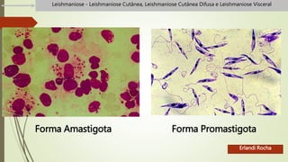 Forma Amastigota Forma Promastigota
Erlandi Rocha
Leishmaniose - Leishmaniose Cutânea, Leishmaniose Cutânea Difusa e Leishmaniose Visceral
 