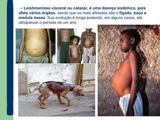 ->  Leishmaniose visceral ou calazar, é uma doença sistêmica, pois afeta vários órgãos , sendo que os mais afetados são o  fígado, baço e medula óssea . Sua evolução é longa podendo, em alguns casos, até ultrapassar o período de um ano.  