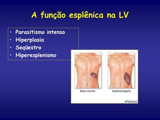 A função esplênica na LV
• Parasitismo intenso
• Hiperplasia
• Seqüestro
• Hiperesplenismo
 