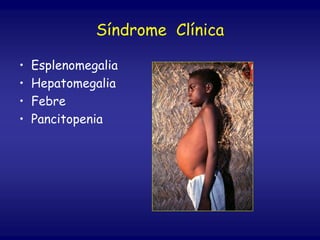 Síndrome Clínica
• Esplenomegalia
• Hepatomegalia
• Febre
• Pancitopenia
 