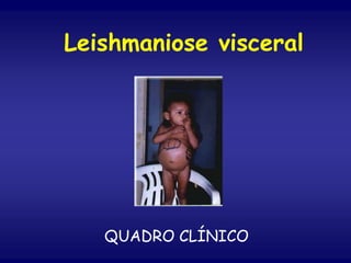 Leishmaniose visceral
QUADRO CLÍNICO
 