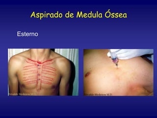 Aspirado de Medula Óssea
Esterno
 