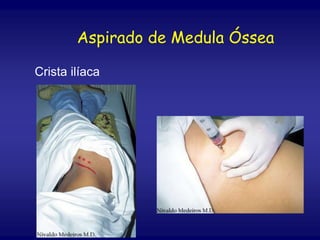 Crista ilíaca
Aspirado de Medula Óssea
 