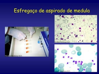 Esfregaço de aspirado de medula
 