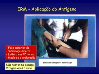 IRM - Aplicação do Antígeno
- Face anterior do
antebraço direito
- Leitura em 72 horas
- Mede-se a enduração
Não reator na doença
Viragem após a cura
 