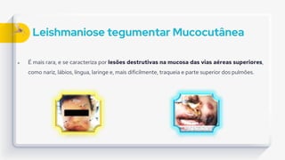 Leishmaniose tegumentar Mucocutânea
 É mais rara, e se caracteriza por lesões destrutivas na mucosa das vias aéreas superiores,
como nariz, lábios, língua, laringe e, mais dificilmente, traqueia e parte superior dos pulmões.
 