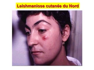 Leishmaniose cutanée du Nord
Leishmaniose cutanée du Nord
 
