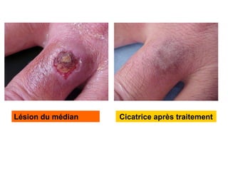 Cicatrice après traitement
Lésion du médian
 